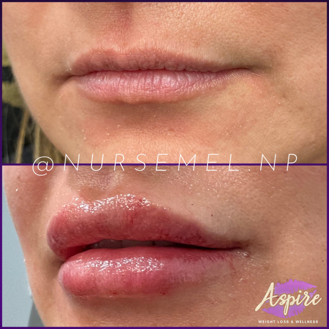 VIP Lip Filler Membership