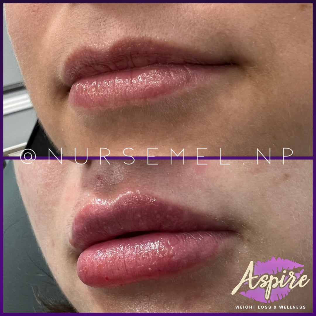 VIP Lip Filler Membership