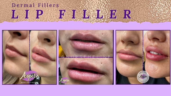 VIP Lip Filler Membership
