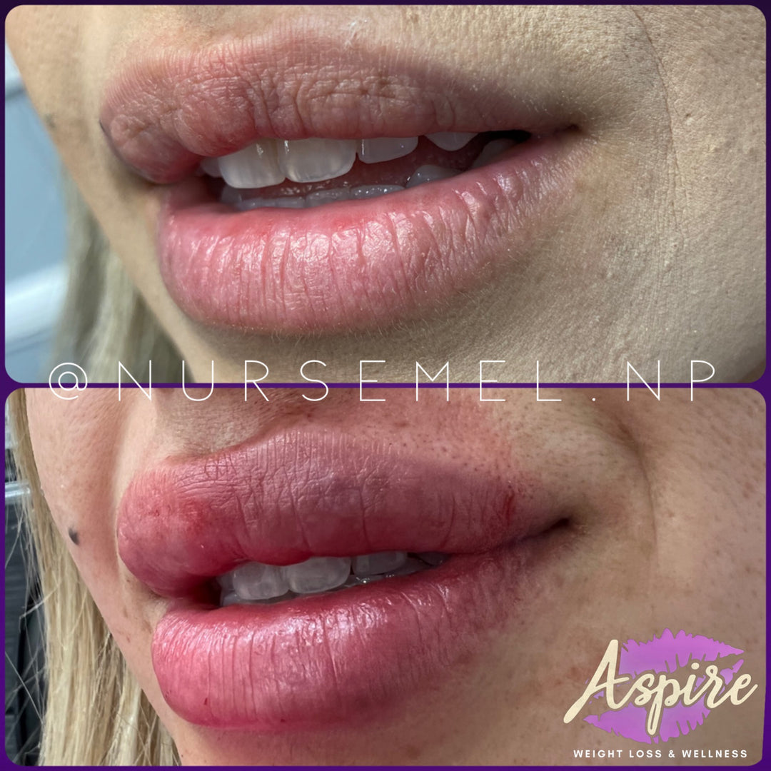 VIP Lip Filler Membership