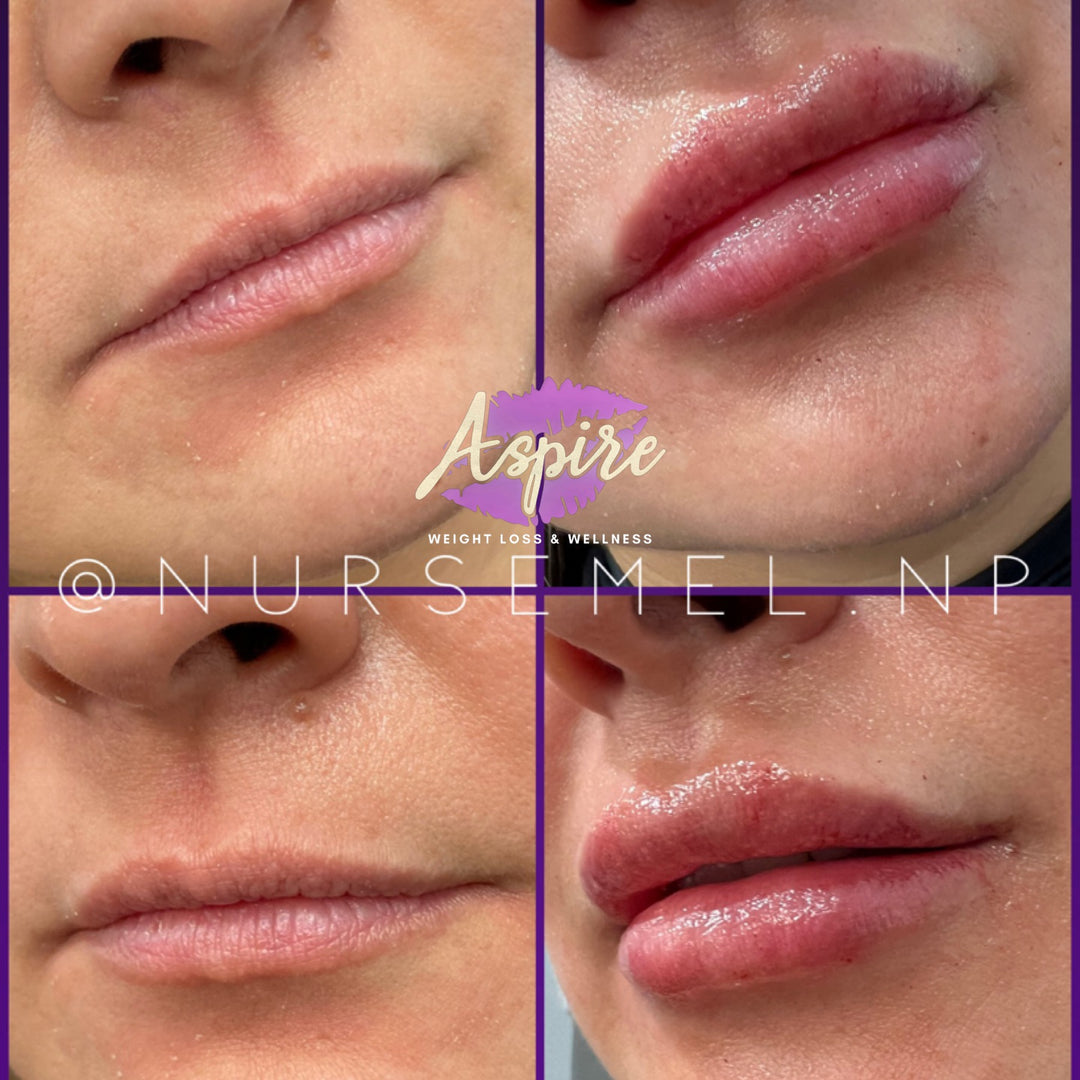 VIP Lip Filler Membership
