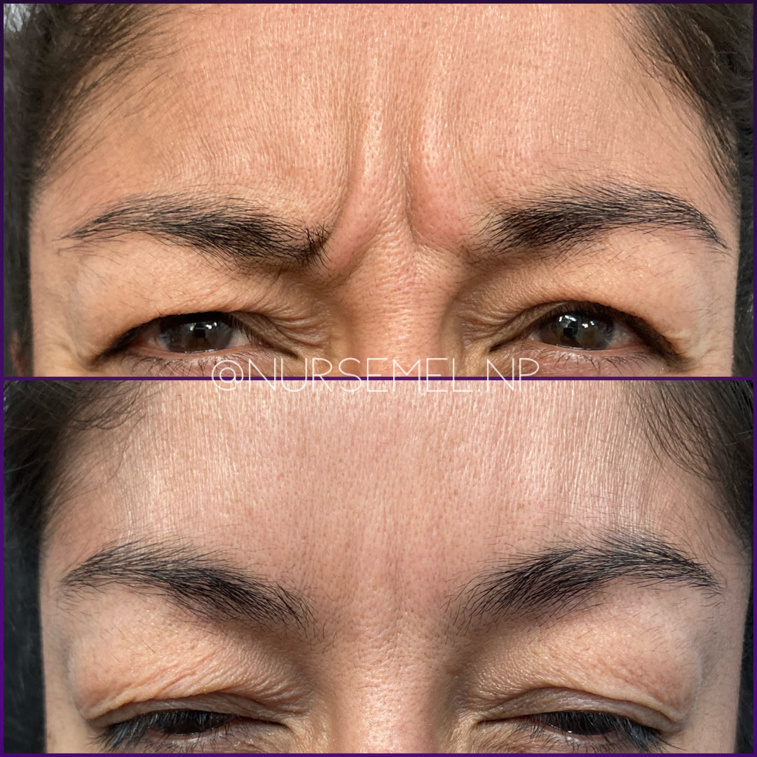 VIP Botox Membership