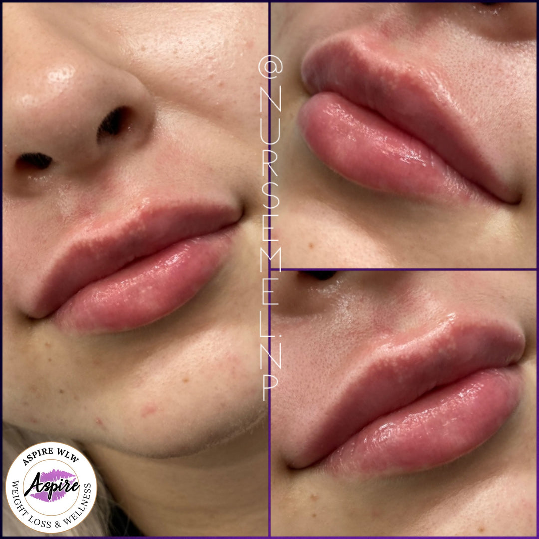 VIP Lip Filler Membership