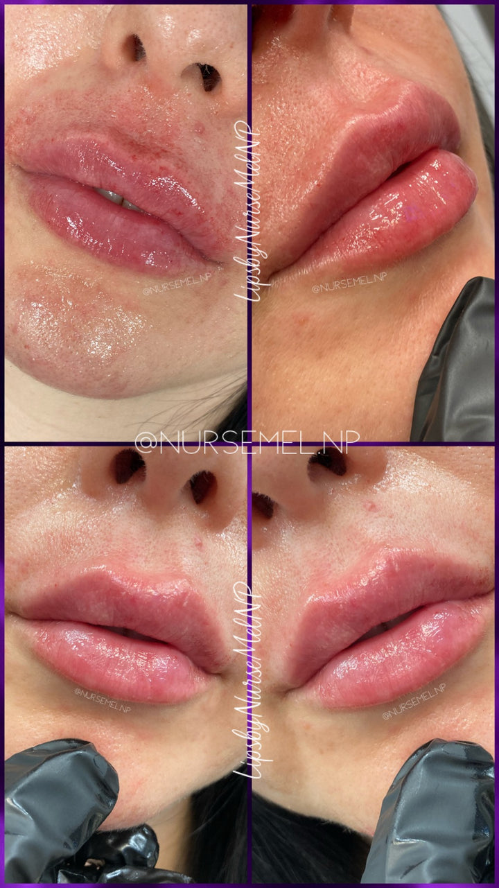 VIP Lip Filler Membership