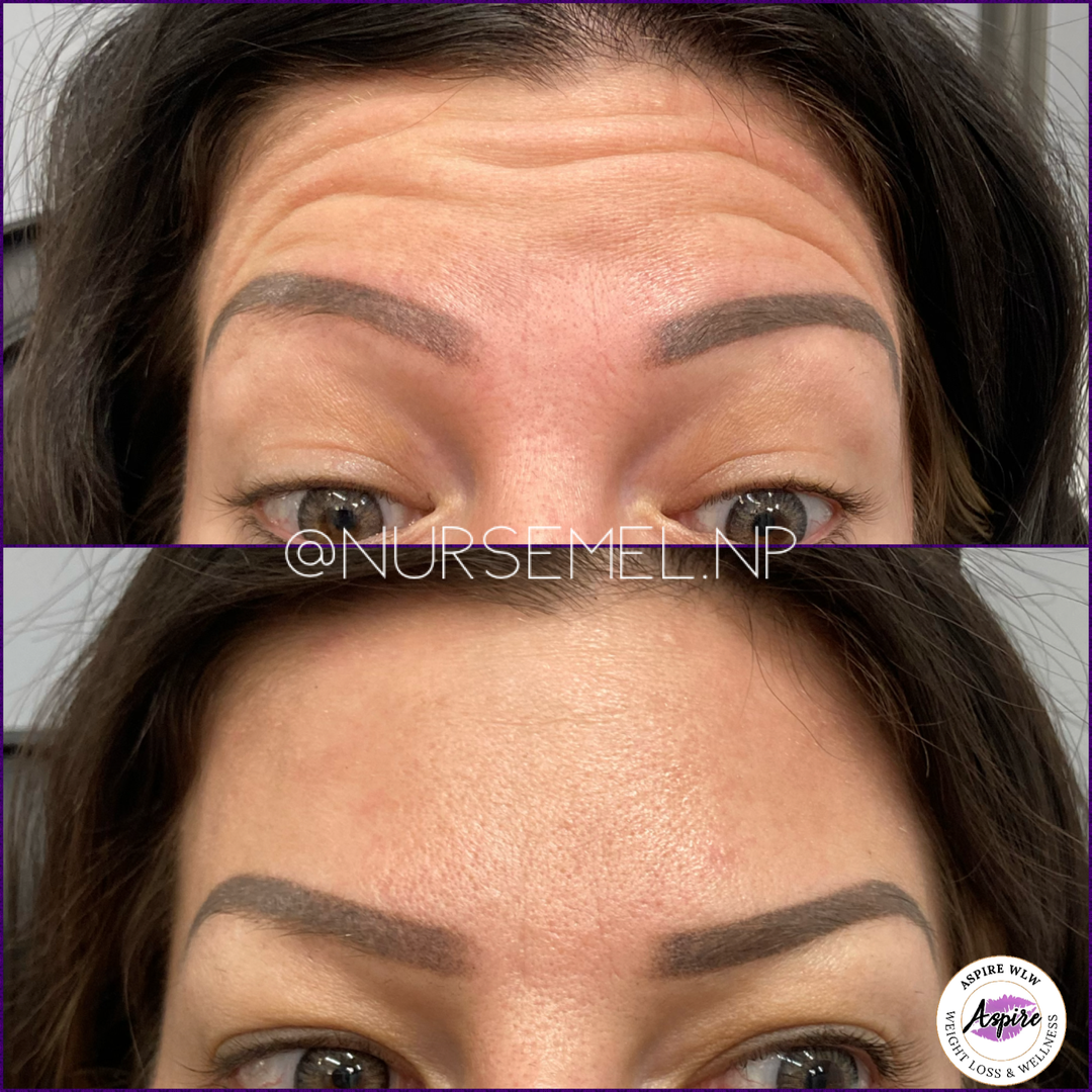 VIP Botox Membership