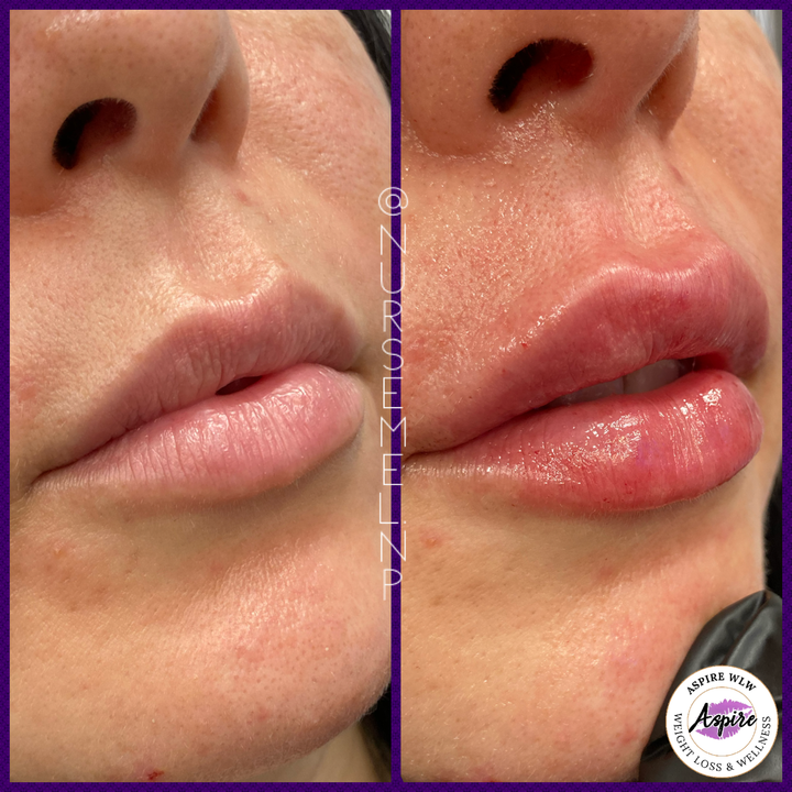 VIP Lip Filler Membership