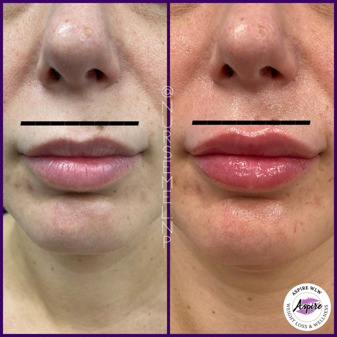 VIP Lip Filler Membership