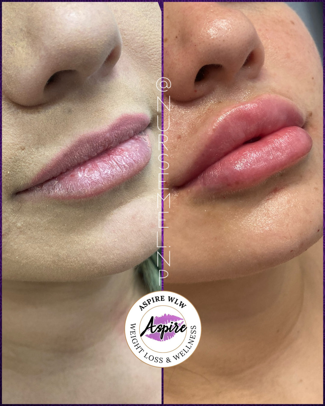 VIP Lip Filler Membership