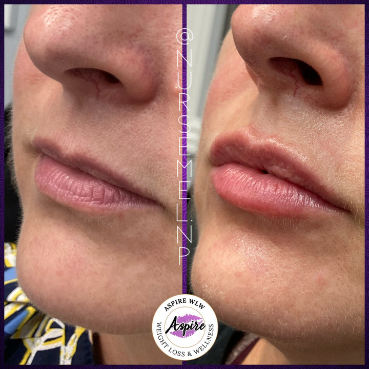 VIP Lip Filler Membership