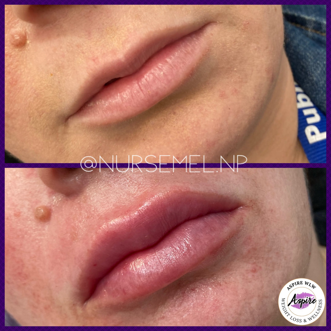 VIP Lip Filler Membership