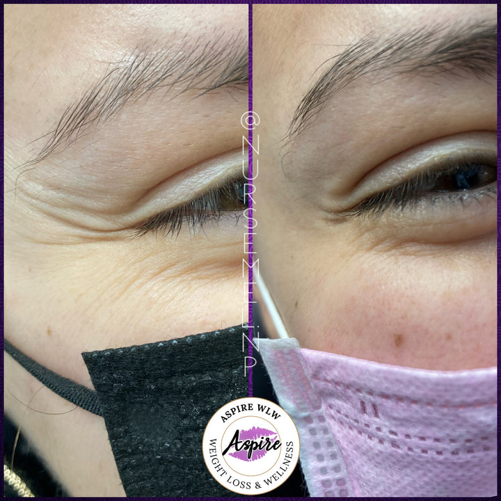 VIP Botox Membership