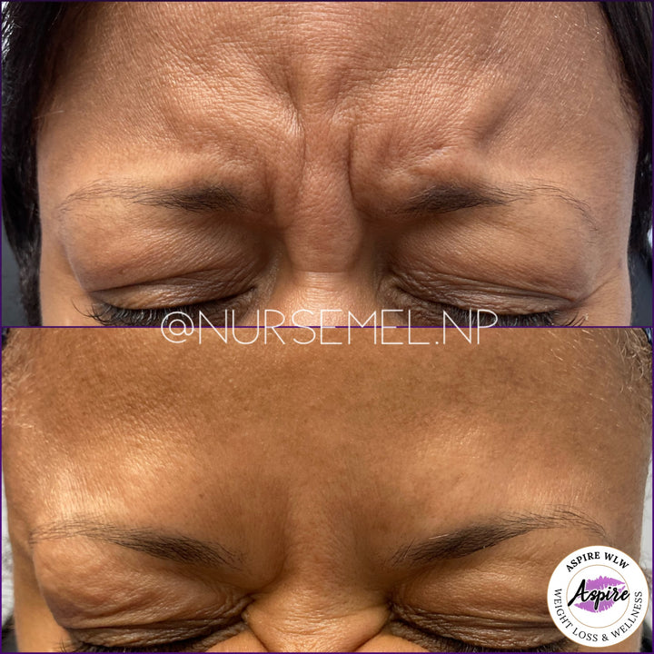 VIP Botox Membership