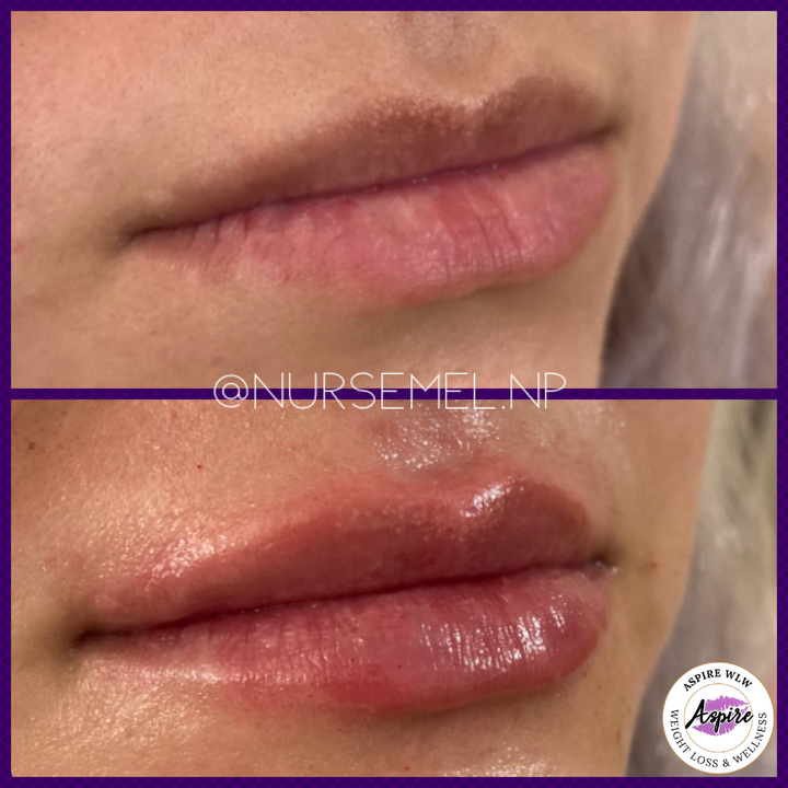 VIP Lip Filler Membership